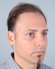 Before Hair Transplant&nbsp;Revision